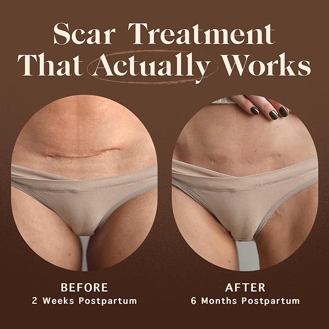 Nemah - Restorative Scar Treatment for C Section Recovery - C Section Scar Treatment for Postpartum - Reduces the Appearance of Scars from Acne - Vegan & Cruelty-Free - 1 oz.