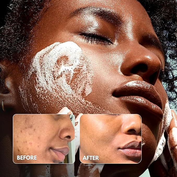 Dr. Melanin Organic Kojic Acid Turmeric Soap for Dark Spots, Hyper-Pigmentation Corrector, Face and Body Brightening Bar - Natural Lemongrass Cleansing Wash