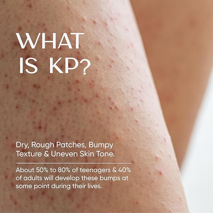 HealFast KP Bump Eraser Cream 4 Oz – Soften, Nourish Rough and Bumpy Skin with 2% BHA – Keratosis Pilaris - For All Types – No Scrubbing Required – Fragrance and Paraben Free