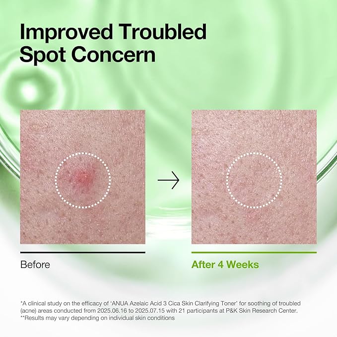 Anua Azelaic Acid 3 CICA Skin Clarifying Toner, Soothing & Clear Care, with Salicylic & Azelaic Acid, Sebum & Spot Care, Suitable for Sensitive Skin, Korean Skincare, 8.45 fl.oz (Pack of 2)