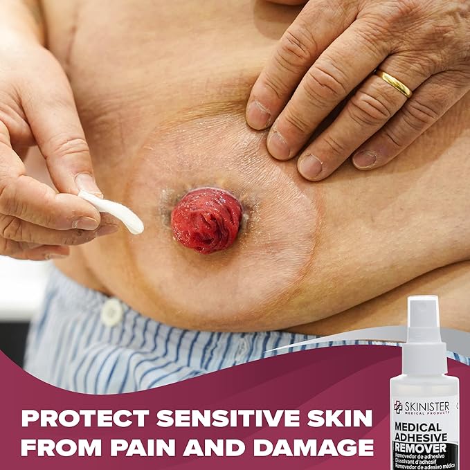 Skinister Adhesive Remover for Skin, 2 Pack – 4oz Each (8oz Total) – Silicone-Based, Hypoallergenic, Sting-Free – for Wig, Ostomy, Tape & Bandage Adhesive Removal
