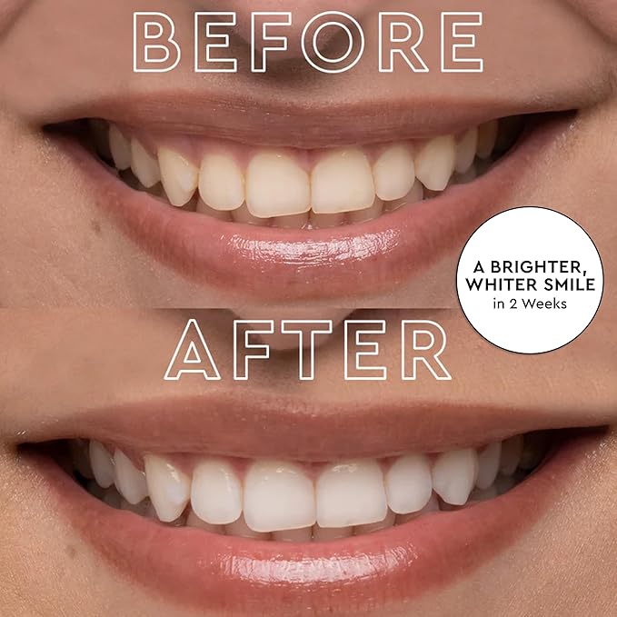 MOON Teeth Whitening Kit, LED Light Teeth Whitener Device, 56 White Strips, USB Charger & Travel Case, Blue Light Whitening Tray Removes Stains & Whitens Up to 12 Shades in 2 Weeks (4 Piece Kit)