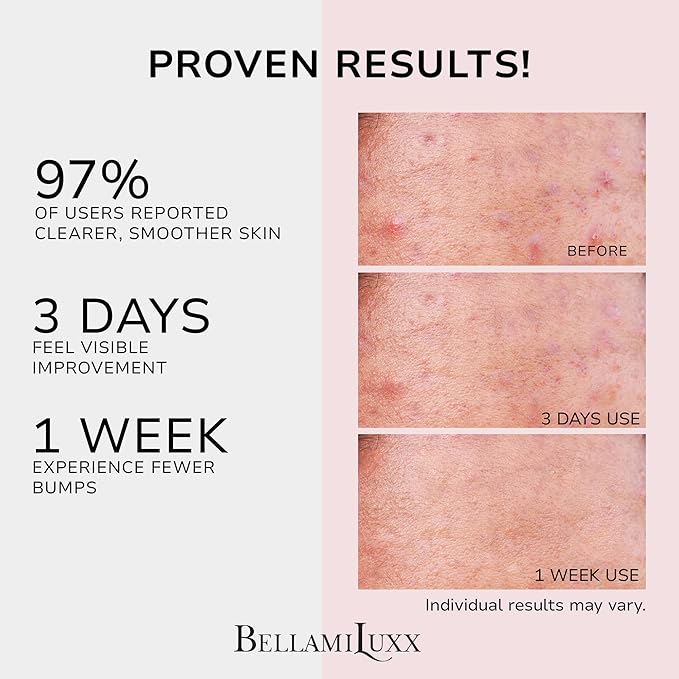 BellamiLuxx Butt Acne Clearing Treatment Cream: Body Acne Treatment for Folliculitis and Pimples on Buttocks, Thighs, and Body with 2% Salicylic Acid & Tea Tree Oil - Butt Cream for Smooth Skin
