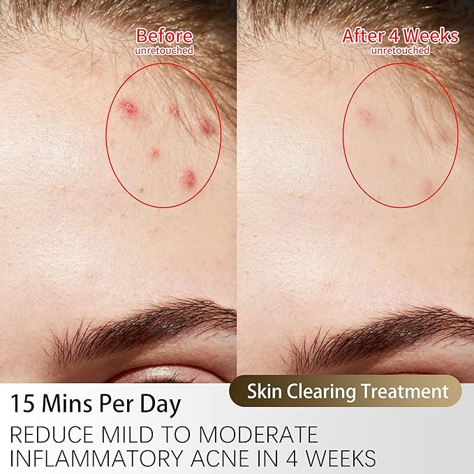 TASNEEM Red Light Therapy for Face, 3D Red Light Therapy Mask with 312 LEDs for Full-face Wrinkles & Acne, 3 Modes with Red & Blue 850nm Near-Infrared Light Therapy Mask, FDA-Cleared, Remote Control