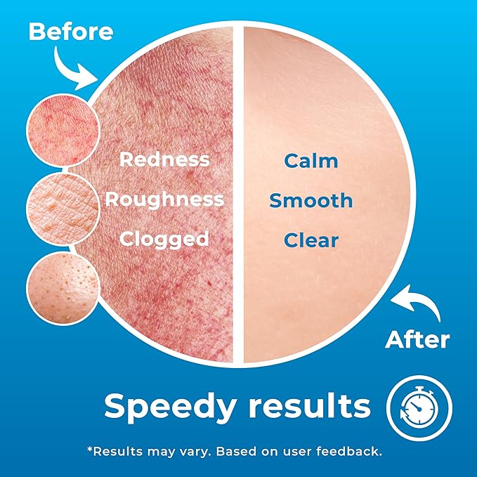 Hypochlorous Acid Spray for Face (8oz, Reduces Acne), Targets Bacteria - HOCL Facial Cleanser Acne Spray for Face, Body, Eczema, Pimples, Breakouts & Overall Skin Recovery (Reduces Redness)