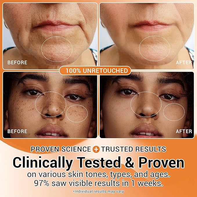 30% Vitamin C Serum with Hyaluronic Acid & Rose Stem Cells – Enhances Anti-Aging Face Serum for Wrinkles, Uneven Skin Tone, Dark Spots, Dull Skin，Korean Microneedling-Like Care 30 Ampoules
