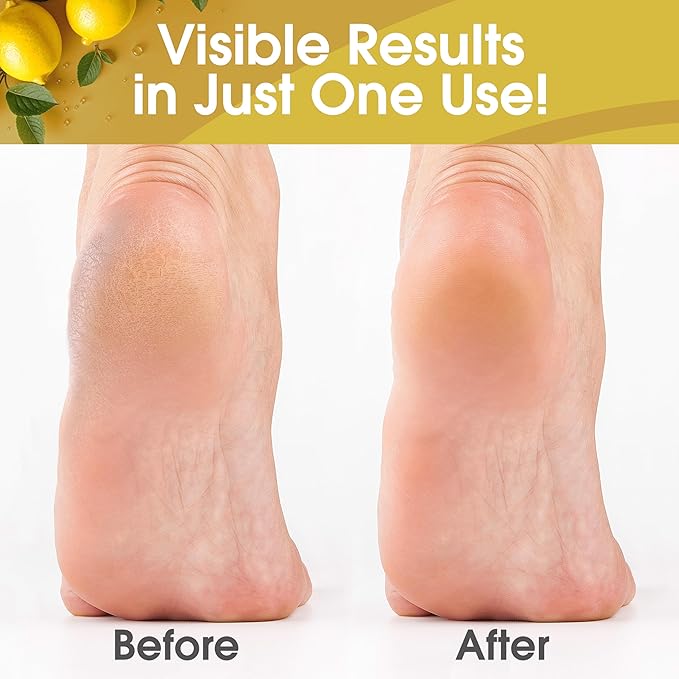 Callus Remover for Feet, Extra Strength Foot Callus Remover Gel, 8oz Salon Grade Home Pedicure Supplies for Dry Skin, Cracked Heel, Professional Strength Foot Care, Lemon