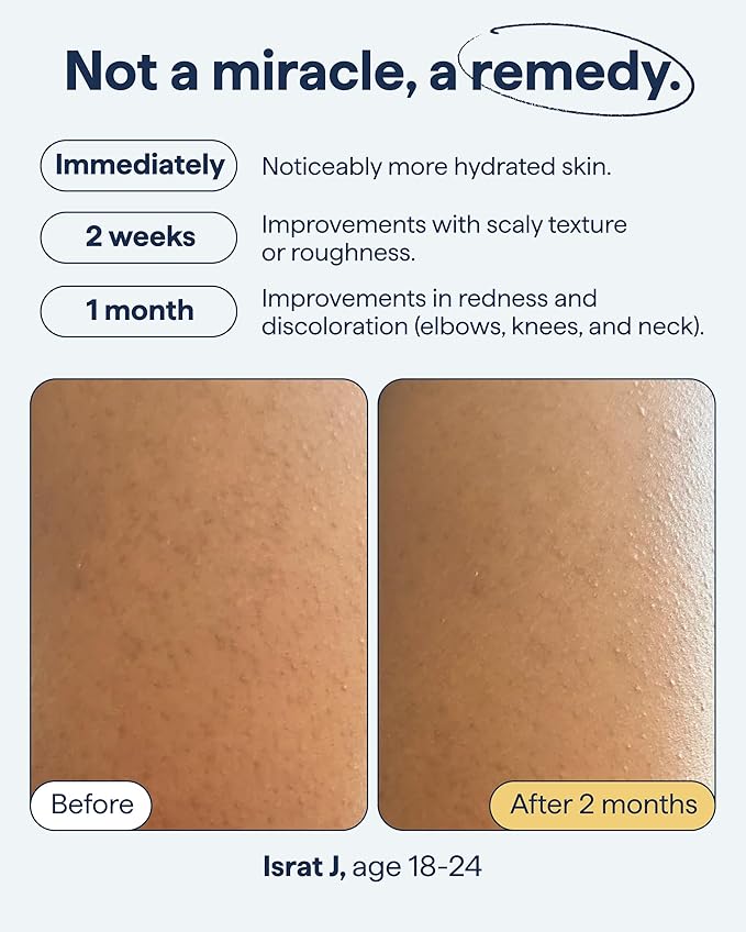 Remedy for Body Bumps | KP Exfoliating Body Moisturizer | Keratosis Pilaris (KP) Treatment For Textured, Crepey Skin with Urea, Lactic Acid, Retinol | Smoothing Body Lotion | By Dermatologist Dr. Shah