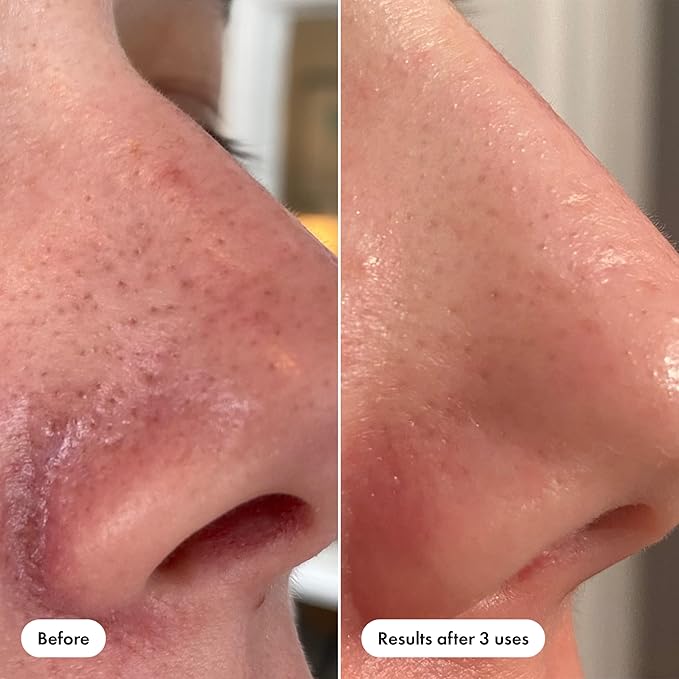 Hero Cosmetics Pore Release Blackhead Clearing Solution, 3.38 Fl Oz | Blackhead Remover Toner; Exfoliating 2% Salicylic Acid Toner Featuring AHA, BHA, and PHA; Acne Treatment