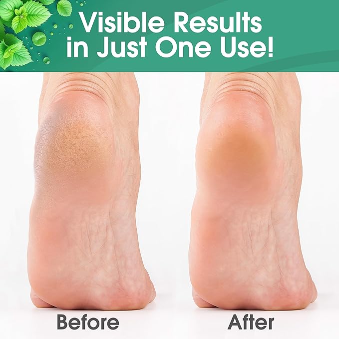 Callus Remover for Feet, Extra Strength Foot Callus Remover Gel, 8oz Salon Grade Home Pedicure Supplies for Dry Skin, Cracked Heel, Professional Strength Foot Care, Cool Mint