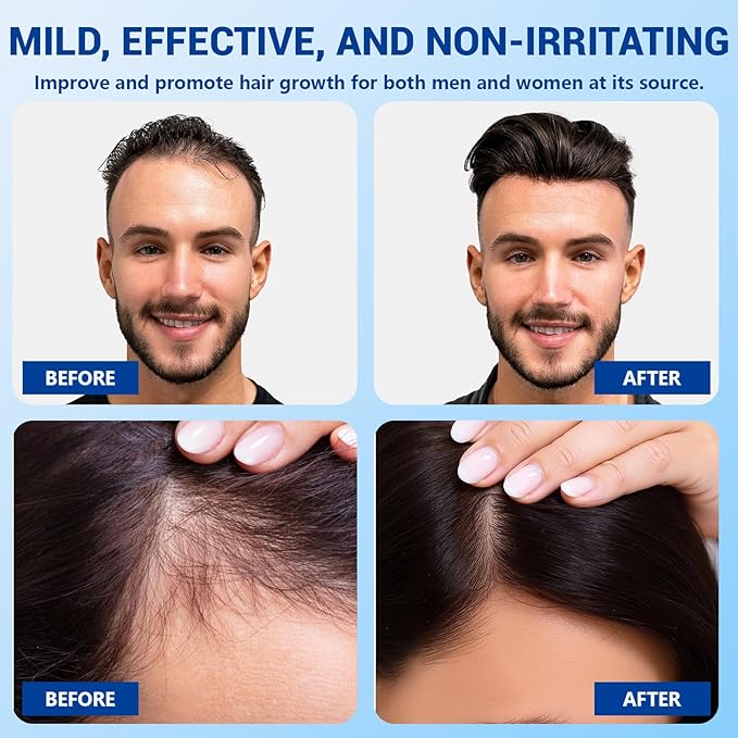 Hair Growth Serum Roll On 30ML, With 3% Batana Castor 2% Biotin Niacinamide 3% Rosemary Oil for Hair Growth No-Rinse, Fast-Absorbing Scalp Serum For Thinning Hair for Men & Women -1.0 Fl OZ