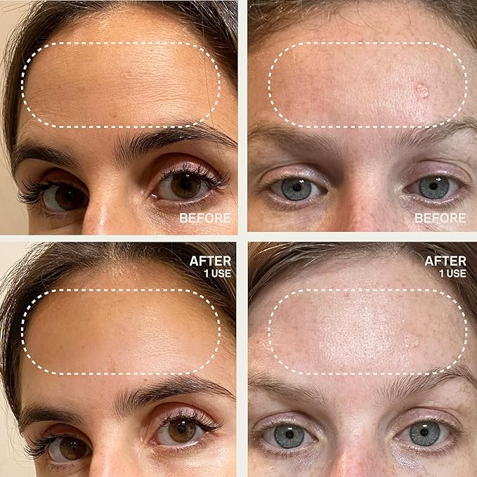 Dermaclara Forehead Patch - Forehead Wrinkle Patches for Face Overnight, Dermaclara Silicone Patches, Reusable for Face, Treatment for Wrinkles, Repair & Restore, Up to 30 Uses - 1 Patch